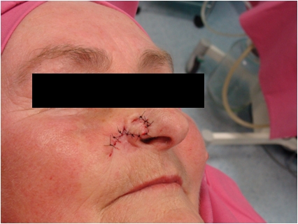 Basal cell carcinoma of the nose